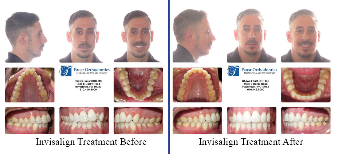 Invisalign For Adults Havertown Haverford Faust Orthodontics