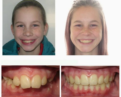 Traditional Braces | Faust Orthodontics