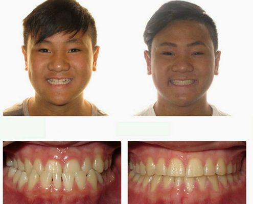 Traditional Braces | Faust Orthodontics