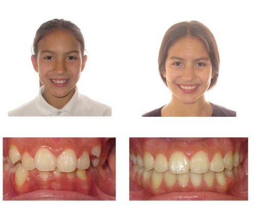 Invisalign | Faust Orthodontics