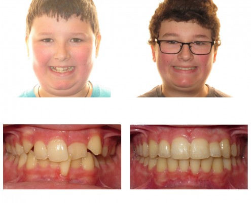 best orthodontist swathmore | Faust Orthodontics Havertown Pa