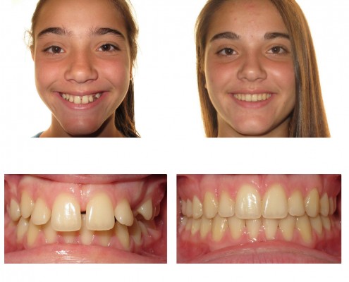 braces newtown square | Faust Orthodontics Havertown Pa