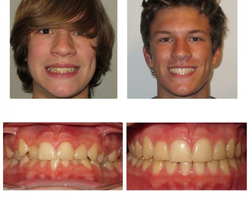 braces villanova | Faust Orthodontics Havertown Pa