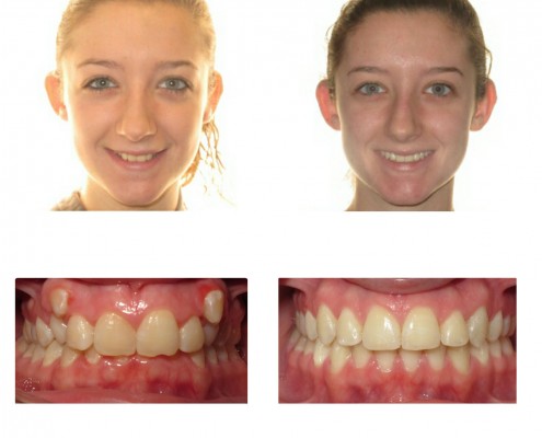 braces bryn mawr | Faust Orthodontics Havertown Pa