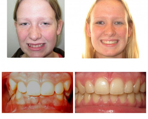 braces Ardmore | Faust Orthodontics Havertown Pa