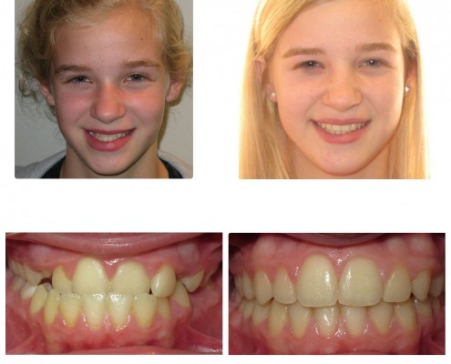 braces havetown | Faust Orthodontics Havertown Pa