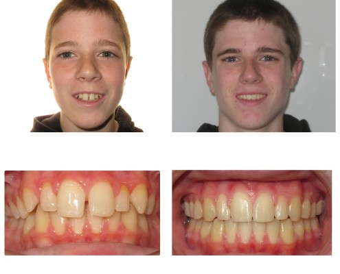 orthodontist before and after | Faust Orthodontics Havertown Pa