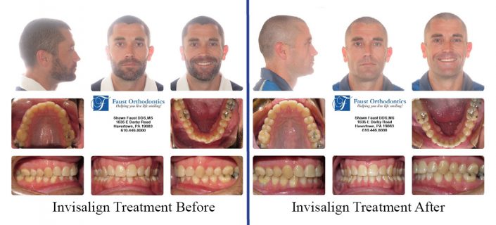 Invisalign Treatment For Adults | Faust Orthodontics