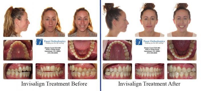 Invisalign Treatment For Adults | Faust Orthodontics