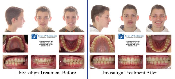 Invisalign Treatment For Teens | Faust Orthodontics