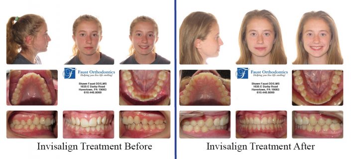 Invisalign Treatment For Teens | Faust Orthodontics