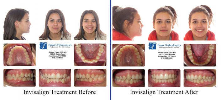 Invisalign Treatment | Faust Orthodontics