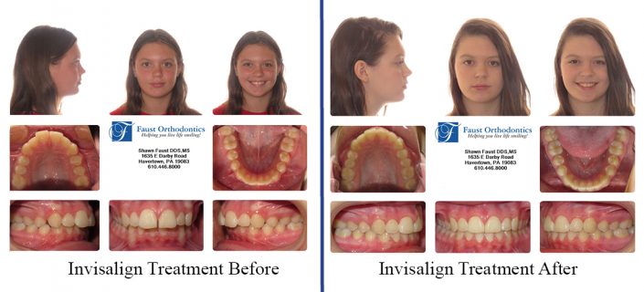 Invisalign for Teens | Faust Orthodontics