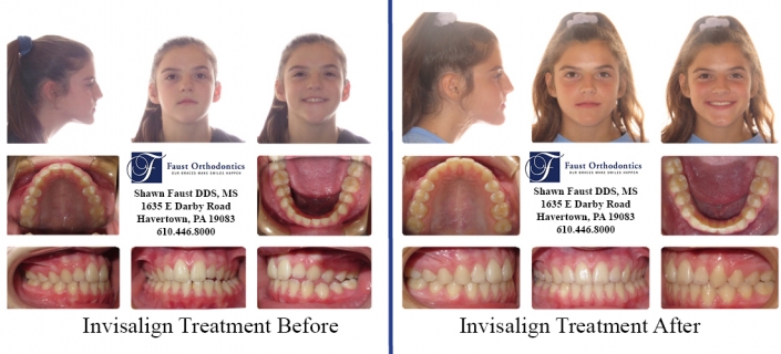 Invisalign Treatment