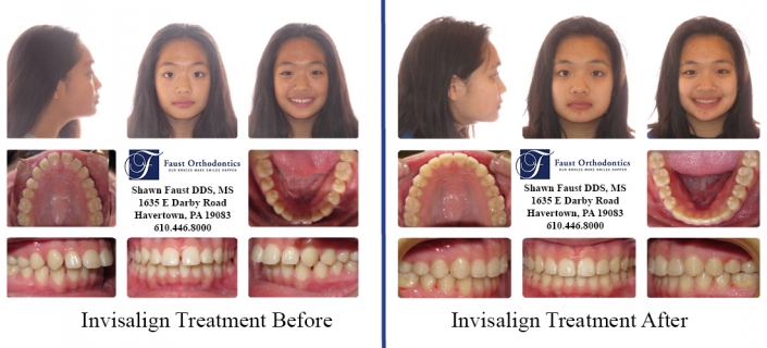 Invisalign Treatment before and after teen