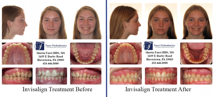 Invisalign Treatment