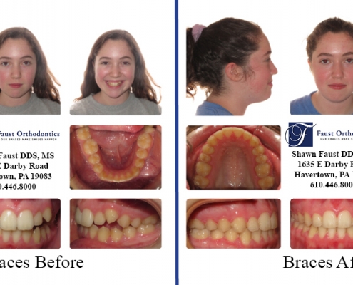 Braces before and after