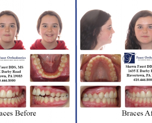 Braces before and after