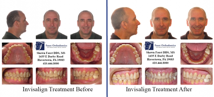 Invisalign Treatment